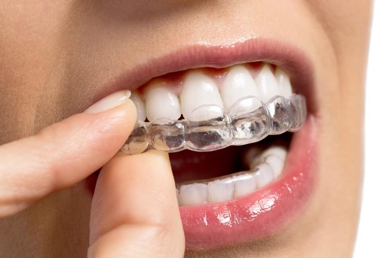 Gouttière transparente Invisalign